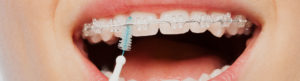 all about braces